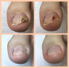 Медицински педикюр по домовете