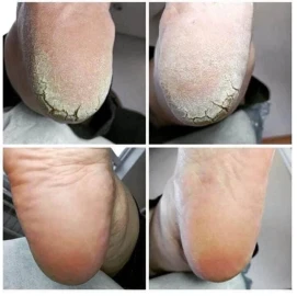 Медицински педикюр по домовете