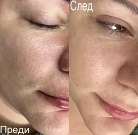Laser Carbon Peel