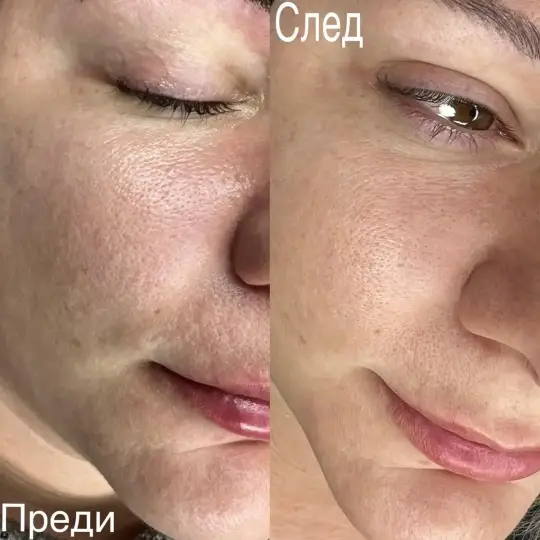 Лазерный карбоновый пилинг