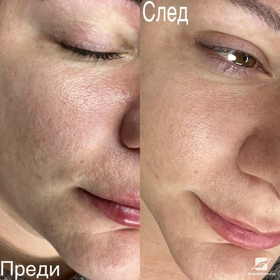 Laser Carbon Peel