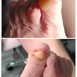 Medical pedicure and Gunaforesis for body and face