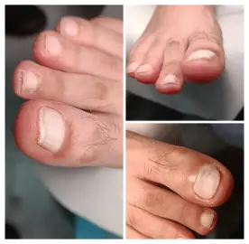 Medical pedicure and Gunaforesis for body and face